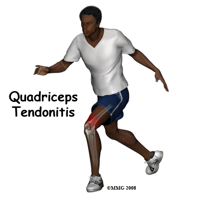 Quadriceps Tendonitis of the Knee Patient Guide