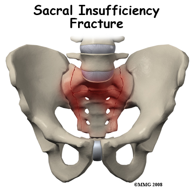 Sacral Insufficiency Fractures